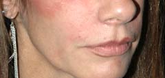 Juvederm New York After Patient 4